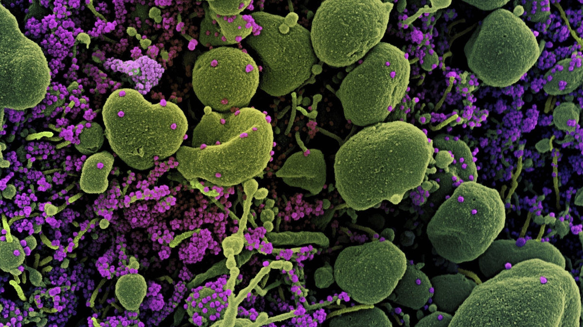 Phát hiện chủng virus SARS-CoV-2 kết hợp giữa 2 biến thể Omicron và Delta