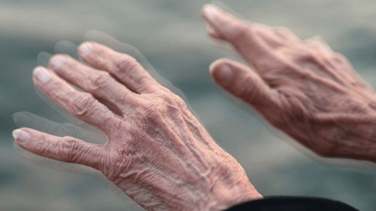 Bệnh COVID-19 có thể làm tăng nguy cơ phát triển bệnh Parkinson, bệnh Parkinson từ Covid