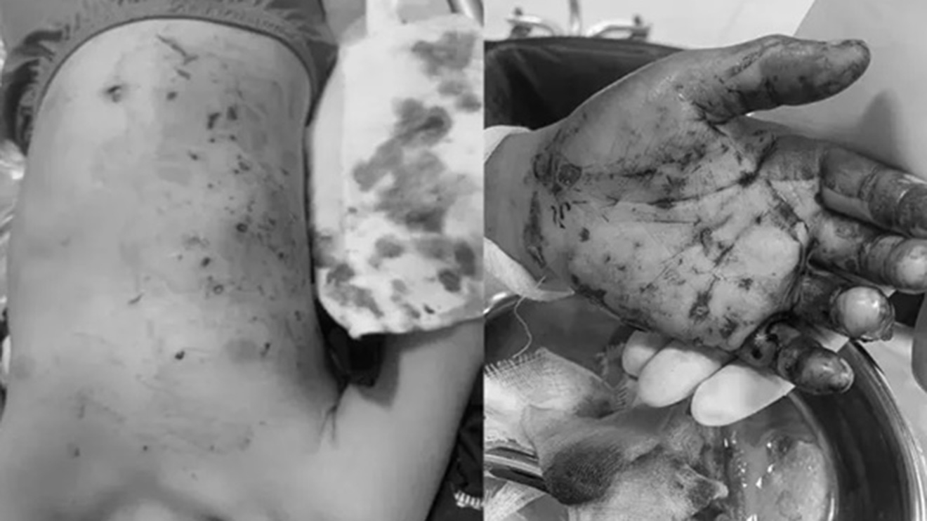 đa chấn thương do nổ pin điều khiển đồ chơi. nổ pin điều khiển. pin điều khiển, pin điều khiển đồ chơi, đa chấn thương, nổ pin, pin nổ